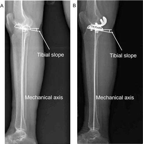 The Influence Of Posterior Tibial Slope Changes On Joint Gap And Range