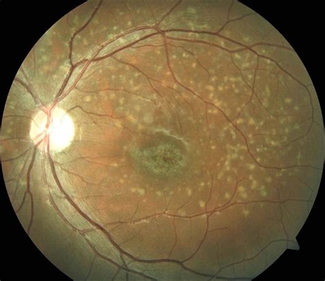 Stargardts Disease Le Retina Image Bank