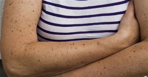 Do You Know What Your Birthmark Says About Your Personality Mq