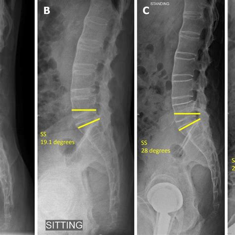 Lateral Lumbosacral Spine Radiographs A Pre Op Standing B Sitting