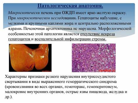 Дистрофия печени диета Острая жировая дистрофия печени. Холестатический гепатоз беременных Острая жировая дистрофия печени. Холестатический гепатоз беременных Дистрофия печени диета