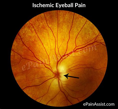 Ischemic Eyeball Pain Or Ocular Ischemic Syndrome Oistypessymptoms