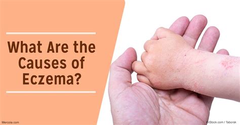 I've had numerous young patients whose parents believe that citrus foods trigger their child's eczema. What Are the Causes of Eczema?