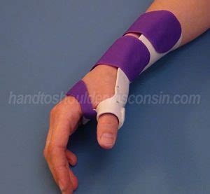 The splint allows the apl and epb tendons to rest, giving them a chance to. De Quervain's Tenosynovitis