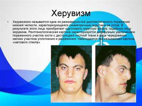 Заболевания костей диета Опухолеподобные заболевания костей лицевого скелета. Одонтогенные кисты Опухолеподобные заболевания костей лицевого скелета. Одонтогенные кисты Заболевания костей диета