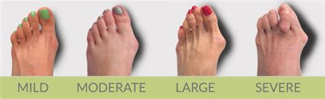 Faqs About Bunion Surgery