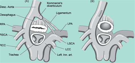 Vascular Ring Right Aortic Arch Mirror Image Branching With Kommerell