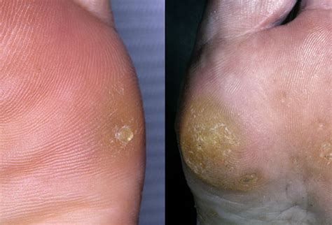 Pictures of corns on your feet. Houston Corns and Calluses | | Tanglewood Foot Specialists