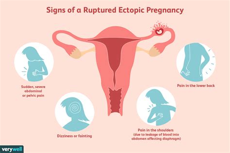 Ectopic Pregnancy Pain