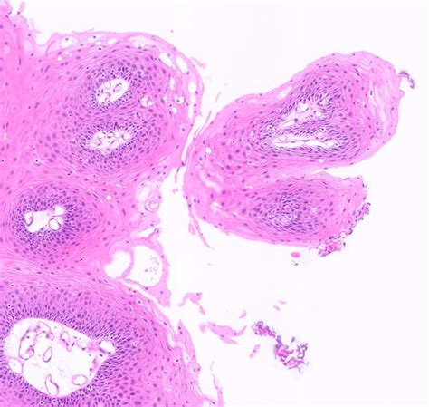Pathology Outlines Squamous Cell Papilloma