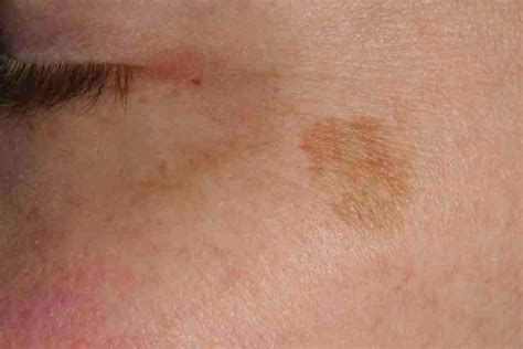 Solar Lentigo Dermatology Conditions And Treatments