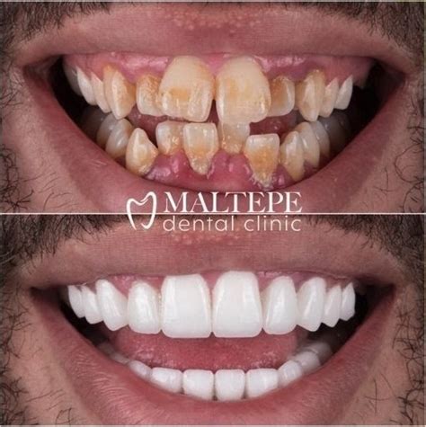 What Are Cosmetic Dentistry Options For Crooked Teeth Maltepe Dental
