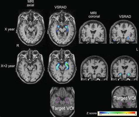 Structural Neuroimaging In Alzheimers Disease Radiology Key