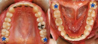You know if you have wisdom teeth by examining your mouth and finding three permanent molars in each dental quadrant. Dentists in Richmond BC - Do I Need My Wisdom Teeth Out?
