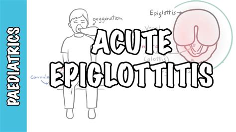 Acute Epiglottitis Signs And Symptoms Causes Pathophysiology