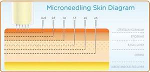 Micro Needling Dermarolling Effective Or Dangerous