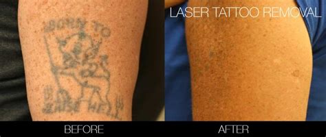 Laser Tattoo Removal Toronto See Before And Afters Spamedica