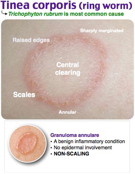 Tinea Corporis Ringworm Kedokteran Medis Kulit