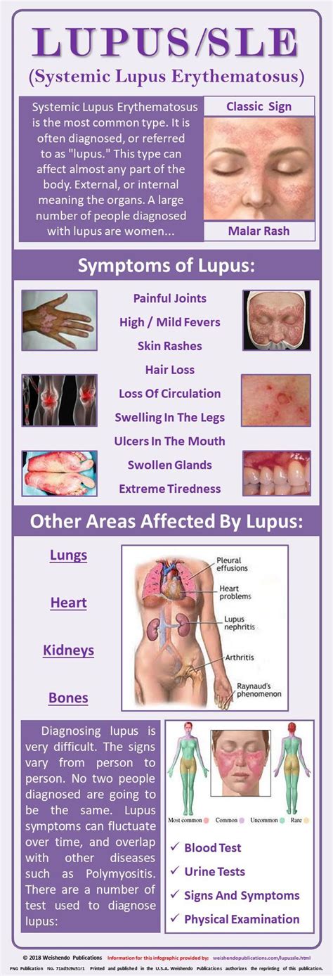 Systemic Lupus Systemic Lupus Erythematosus Is The Most Common Type