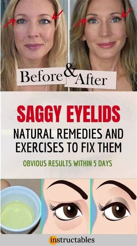 Droopy Eyelid Exercises 5 Exercises And Some Remedies To Fix