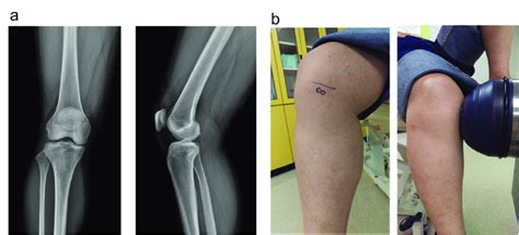 A The Knee Radiography Showed Kellgren Lawrence Classification Grade