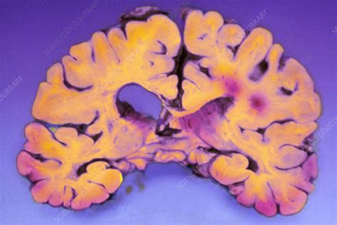 Slice Of Human Brain With Multiple Sclerosis Spots Stock Image M210