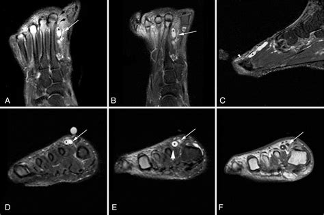 Figure 1 From Magnetic Resonance Imaging Of A Deep Peroneal Intraneural