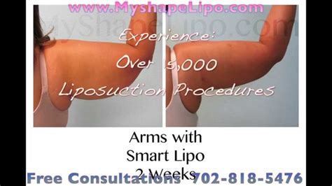 Arms Liposuction Before And After Myshape Lipo Youtube