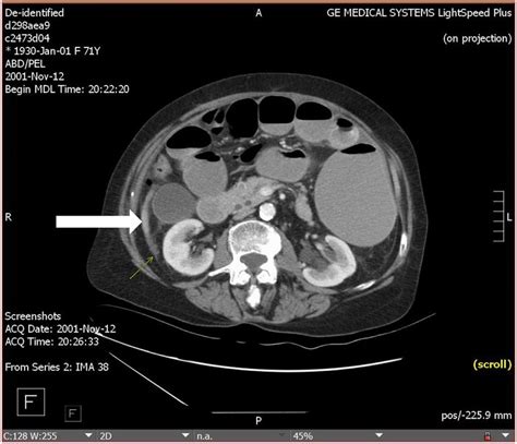 Ct Scan Showing Bowel Obstruction And Peritoneal Thickening Due To