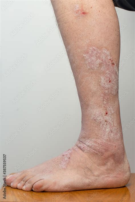 Psoriasis The Patients Leg Is Covered With Rashes Wounds Ulcers