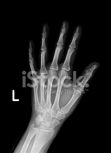 Xray Image Of Left Hand And Wrist Stock Photo Royalty Free Freeimages