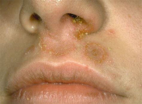 Staph Infection On Lips Pictures