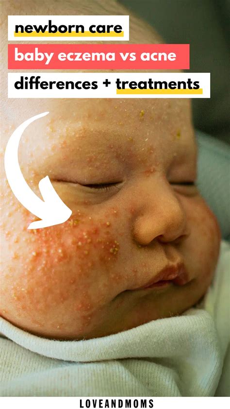 Baby Eczema Vs Acne How To Tell The Difference Love And Moms