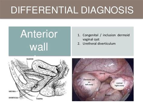 Pelvic Organ Prolapse