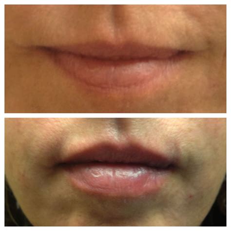 Juvéderm Lips Better Skin Diy Lip Gloss Lip Fillers