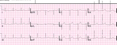 Dr Smiths Ecg Blog Is It Wellens Syndrome