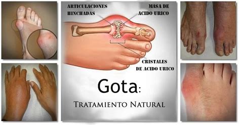 Su fórmula química es c5h4n4o3. Dile Adiós al Acido Urico Para Siempre y a La Gota Con ...