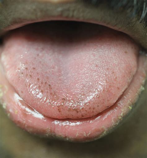 Pigmented Funorm Papillae Of The Tongue In An Indian Male Mdedge