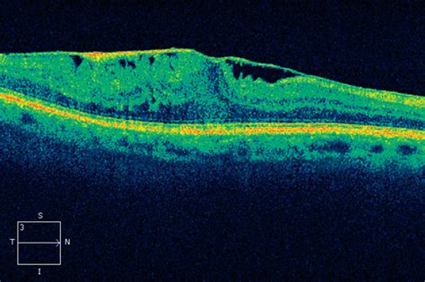 Diagnose My Retinal Photo Epiretinal Membrane Eyedolatry