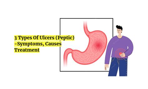 Peptic Ulcer Symptoms Causes Risks Treatment By Dr Dawood Ismail My XXX Hot Girl