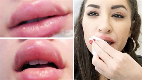 3 things to consider when getting lip injections healthtian