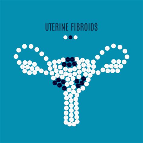 Uterine Fibroids What You Need To Know Womens Healthcare