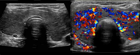 Graves' disease is an autoimmune thyroid condition associated with hyperthyroidism. Graves disease - Radiology at St. Vincent's University ...