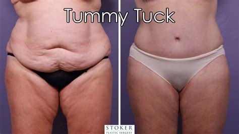 Tummy Tuck And Liposuction Los Angeles Plastic Surgeon Dr David Stoker Explains In Detail