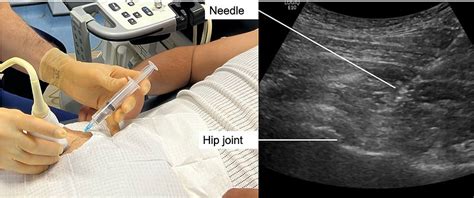Hip Osteoarthritis Cortisone Injection Musculoskeletal Ultrasound