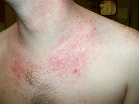 Moderate Form Of Atopic Dermatitis With Maculopapulous Rash Download
