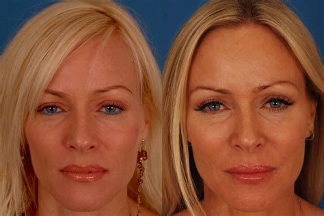 Botox Before And After Photos Benjamin Bassichis Md Facs