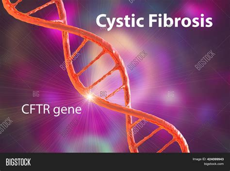Cystic Fibrosis Image And Photo Free Trial Bigstock