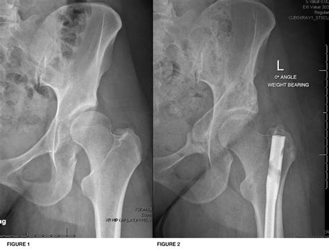 Derotational Femoral Osteotomy Dfo Cu Sports Med Hip Clinic