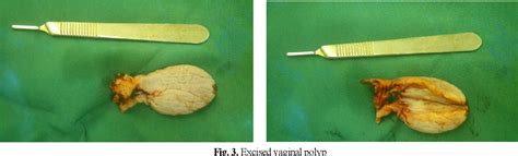 Figure 2 From An Unusual Presentation Of Giant Fibroepithelial Polyp Of